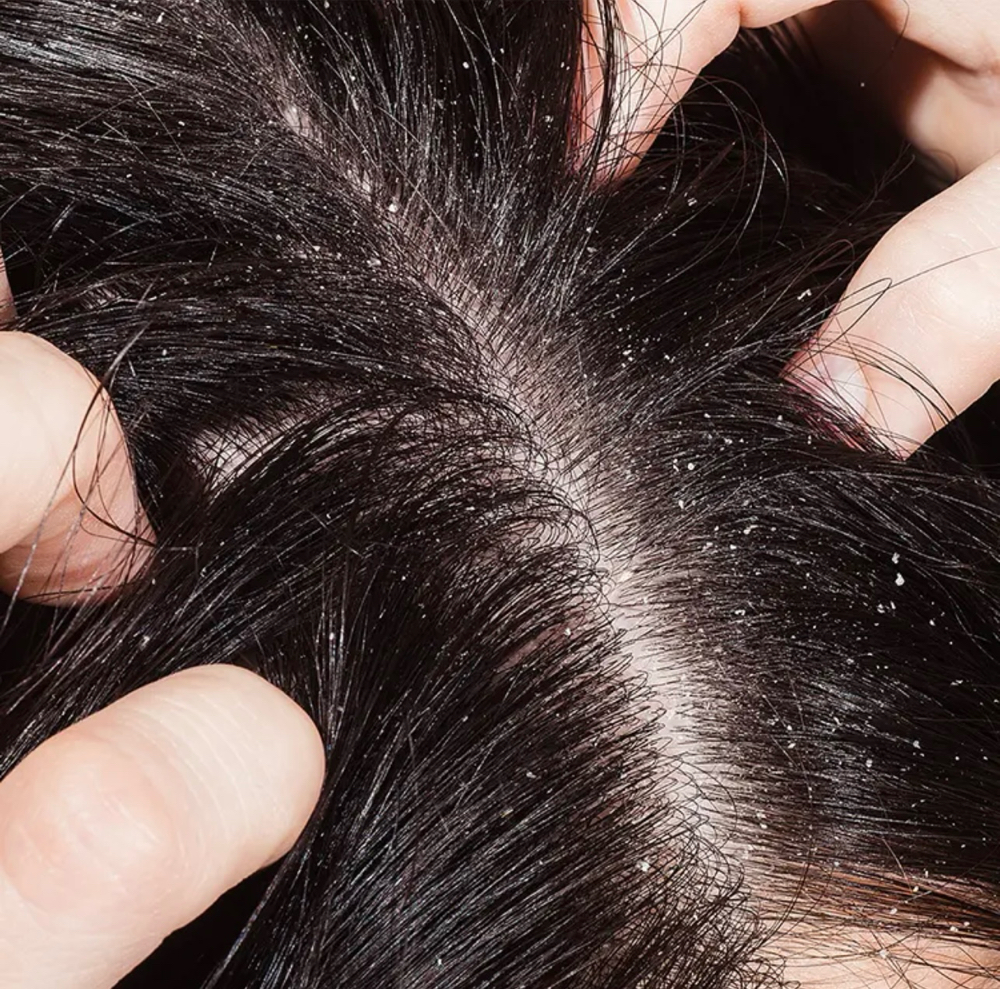 Dry Scalp Treatment at Transformations by Mindy in Wayne, WV