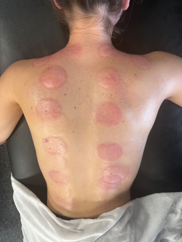 Cupping