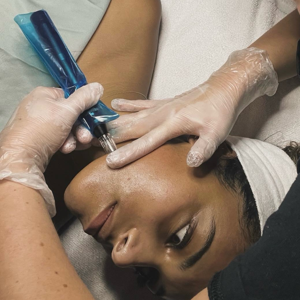 Microneedle Treatments