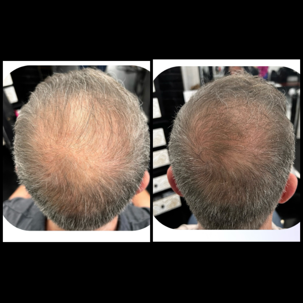 Procell Hair Treatments