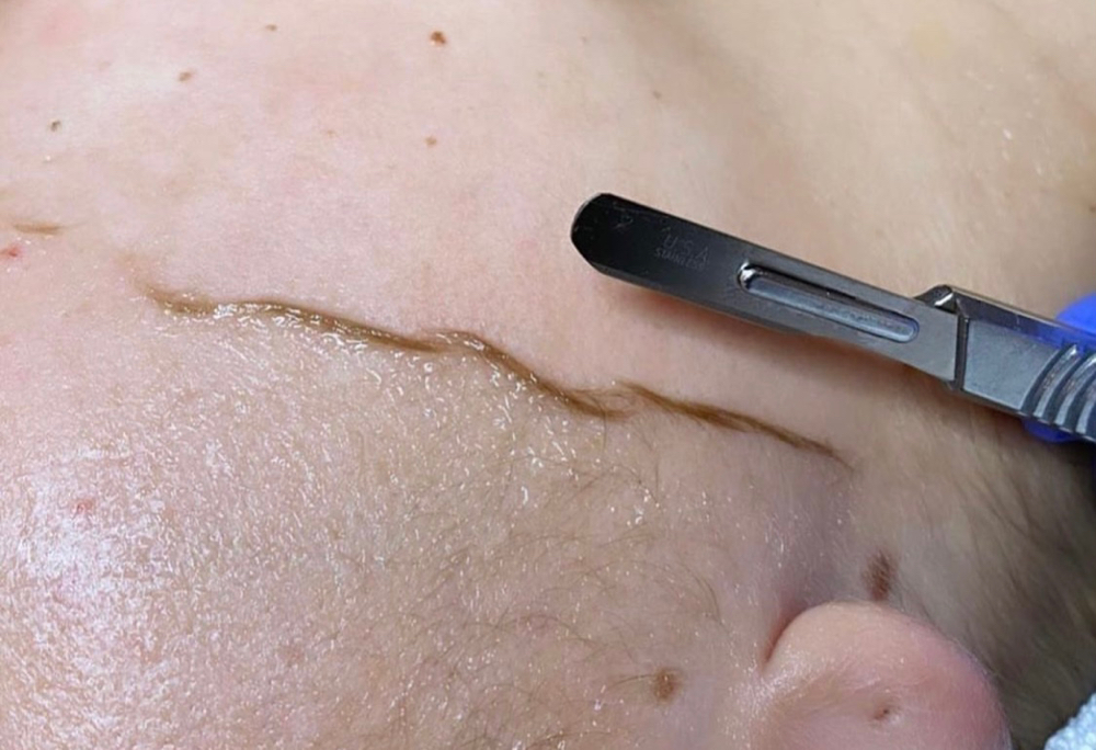 Dermaplane Facial
