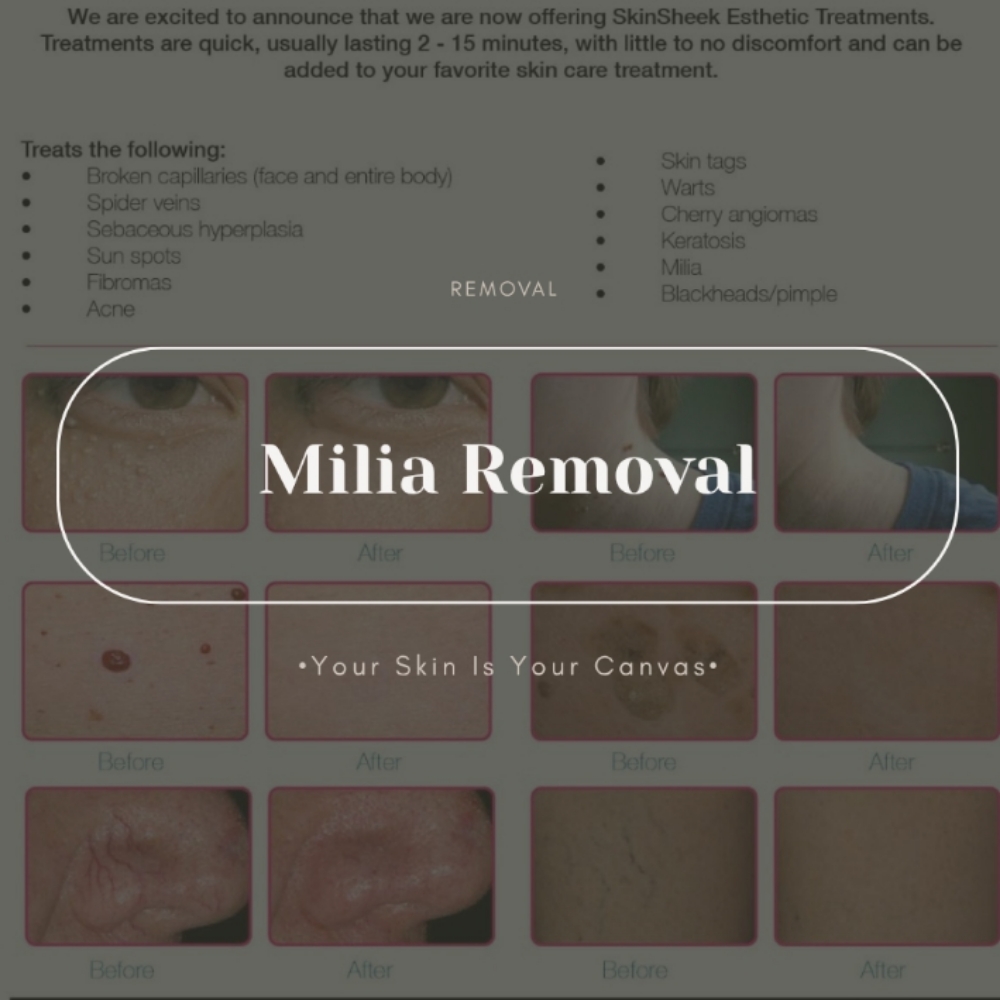 Milia Removal at Face Palette Aesthetics in Franklin, WI