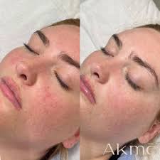 Oxygen Facial