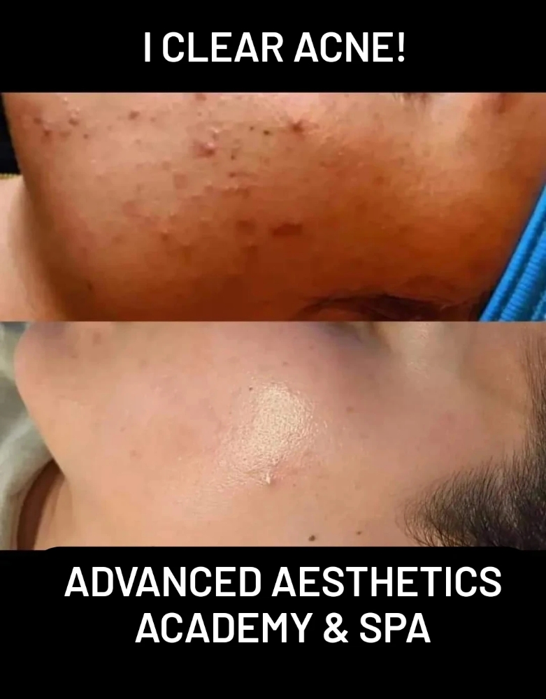 Advanced Acne Treatment