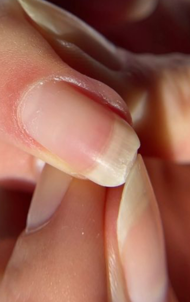 Nail Repair