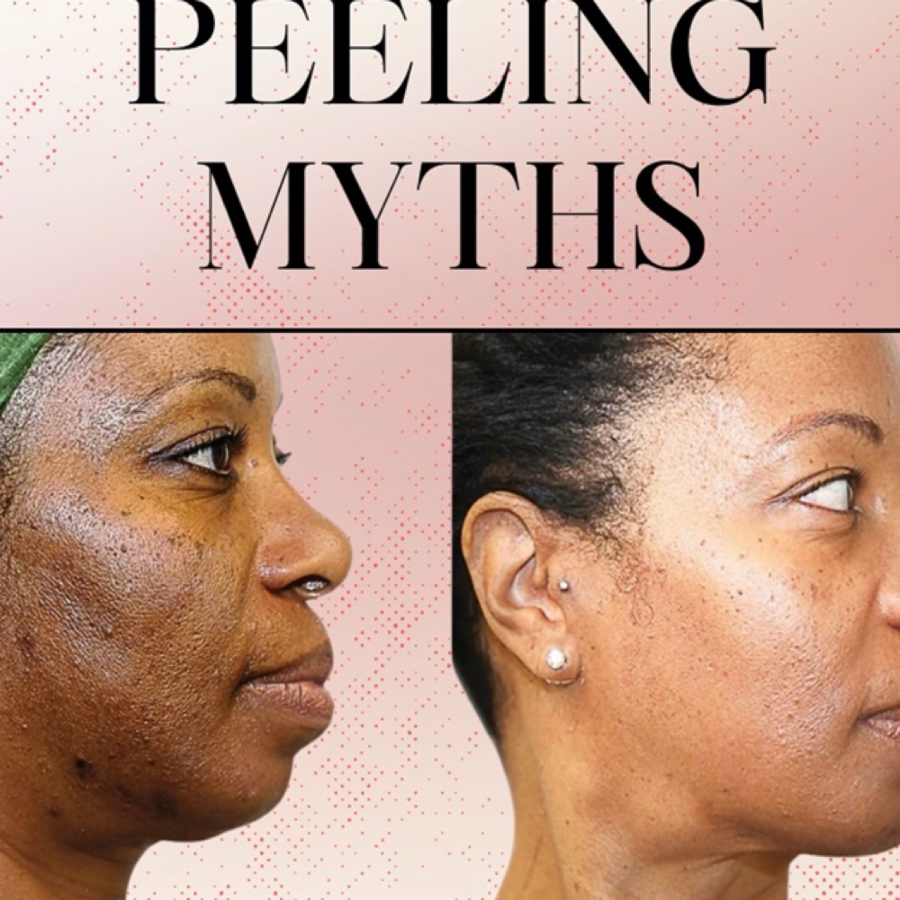 Chemical Peel at Cherished Aesthetics in Snellville, GA
