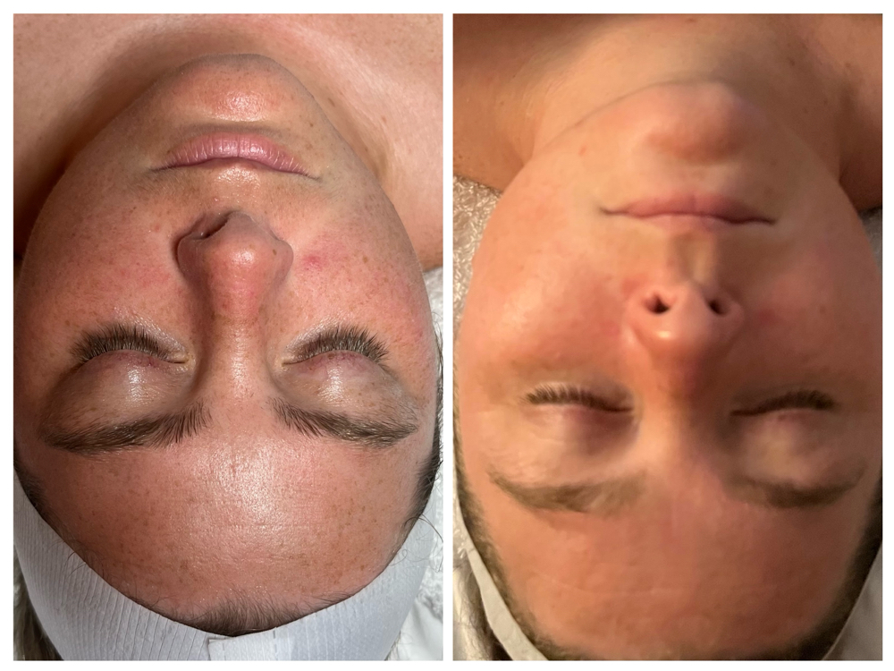 Dermaplane Facial