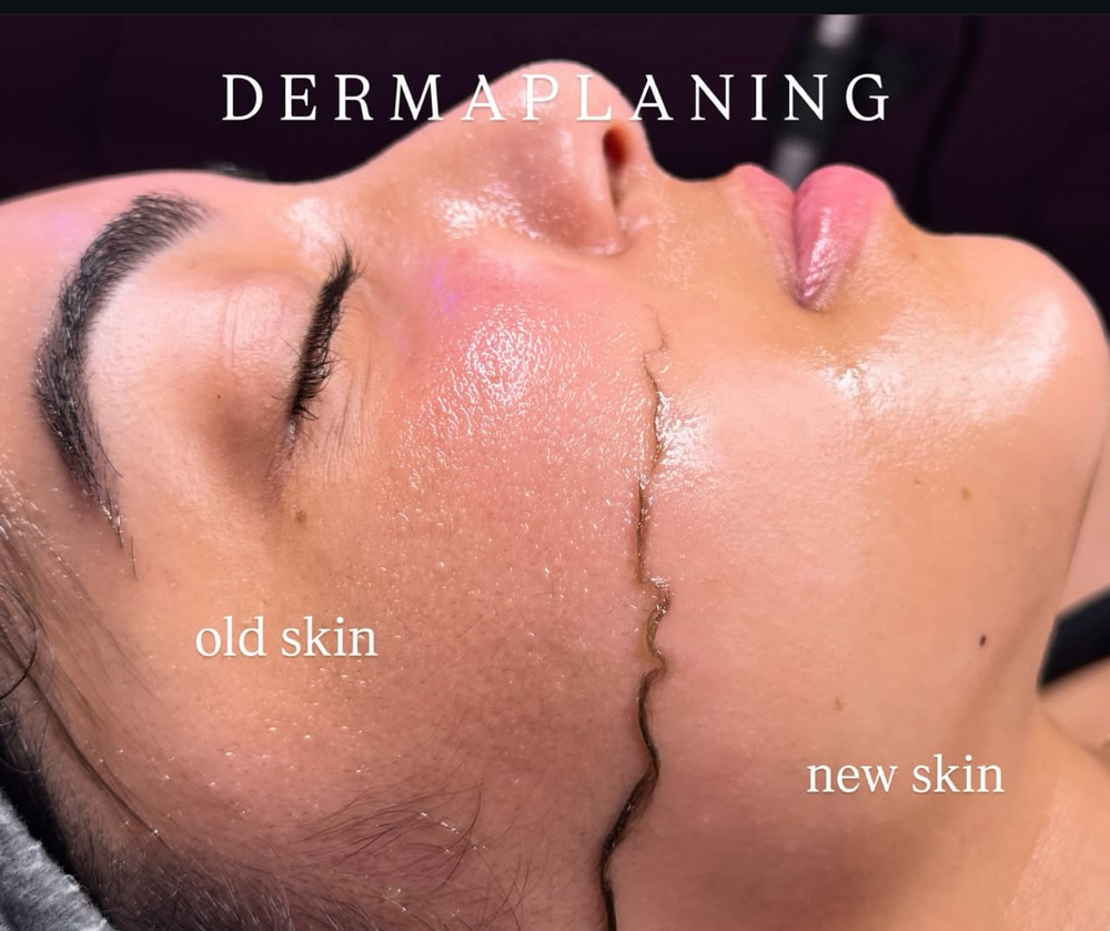 DERMAPLANING FACIAL