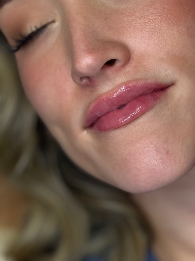 Half syringe - lip filler at Esteem Aesthetics, LLC in Charleston, WV