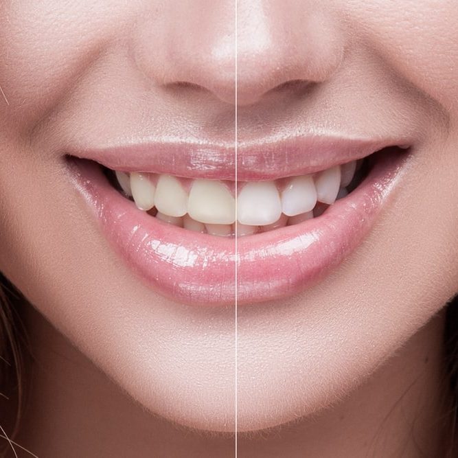 Sensitive / Mild whitening service