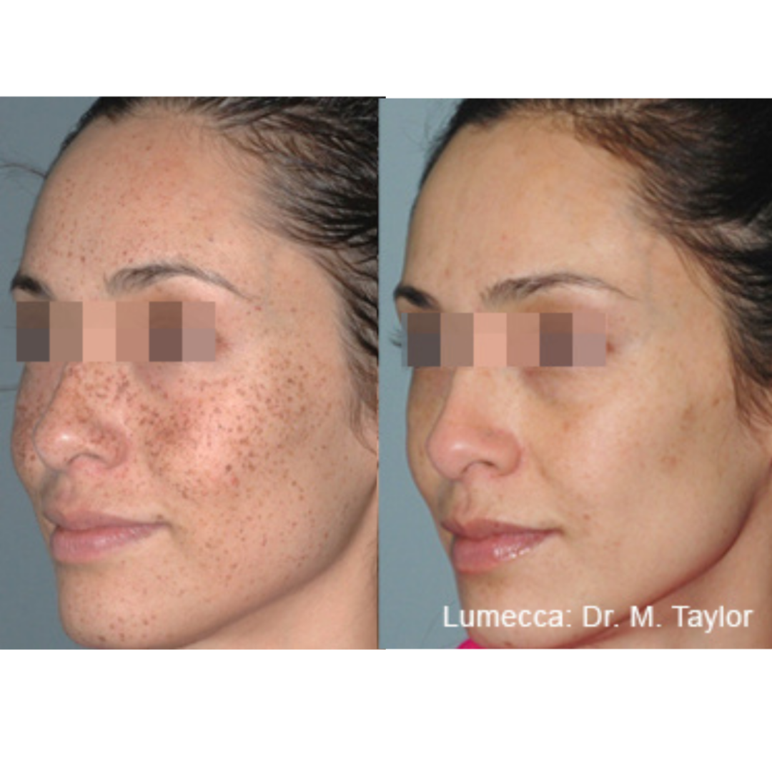 Skin Rejuvenation at Meraki Artistry in Greenwood, IN