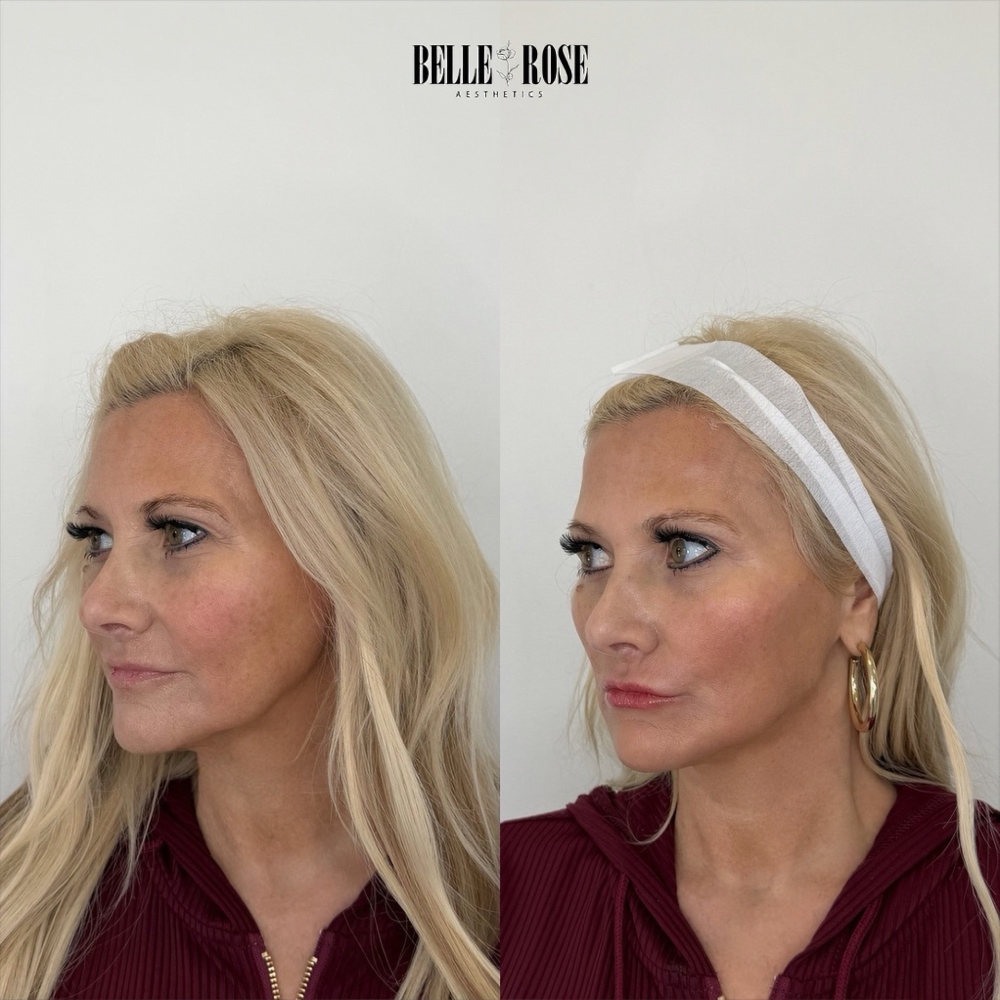 FACIAL BALANCING 4 POINT at Belle Rose Aesthetics in Oklahoma City, OK