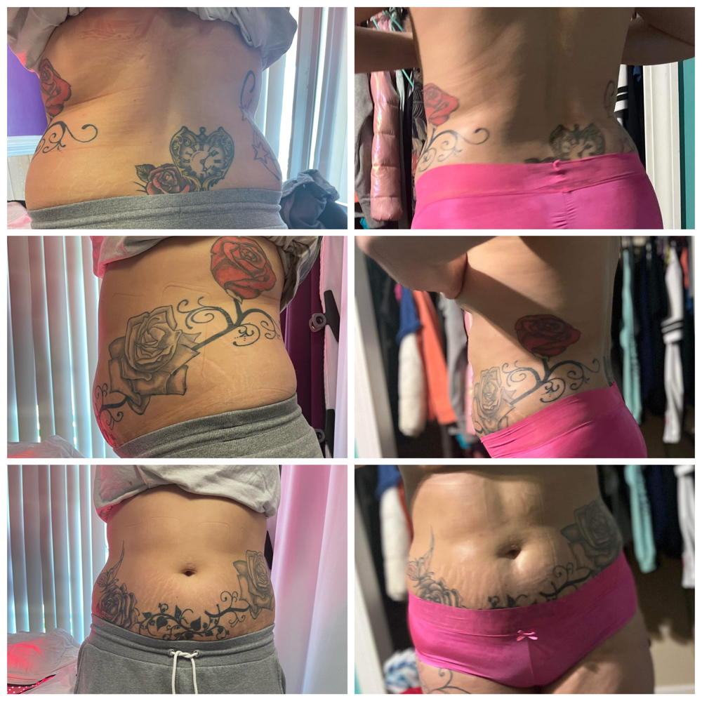 Stomach & Back Injections/Butt Injections