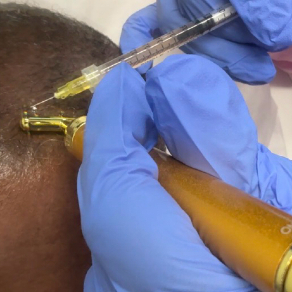PRP Hair/3 treatments at Trilogy Aesthetics Medspa & Wellness in Atlanta, GA