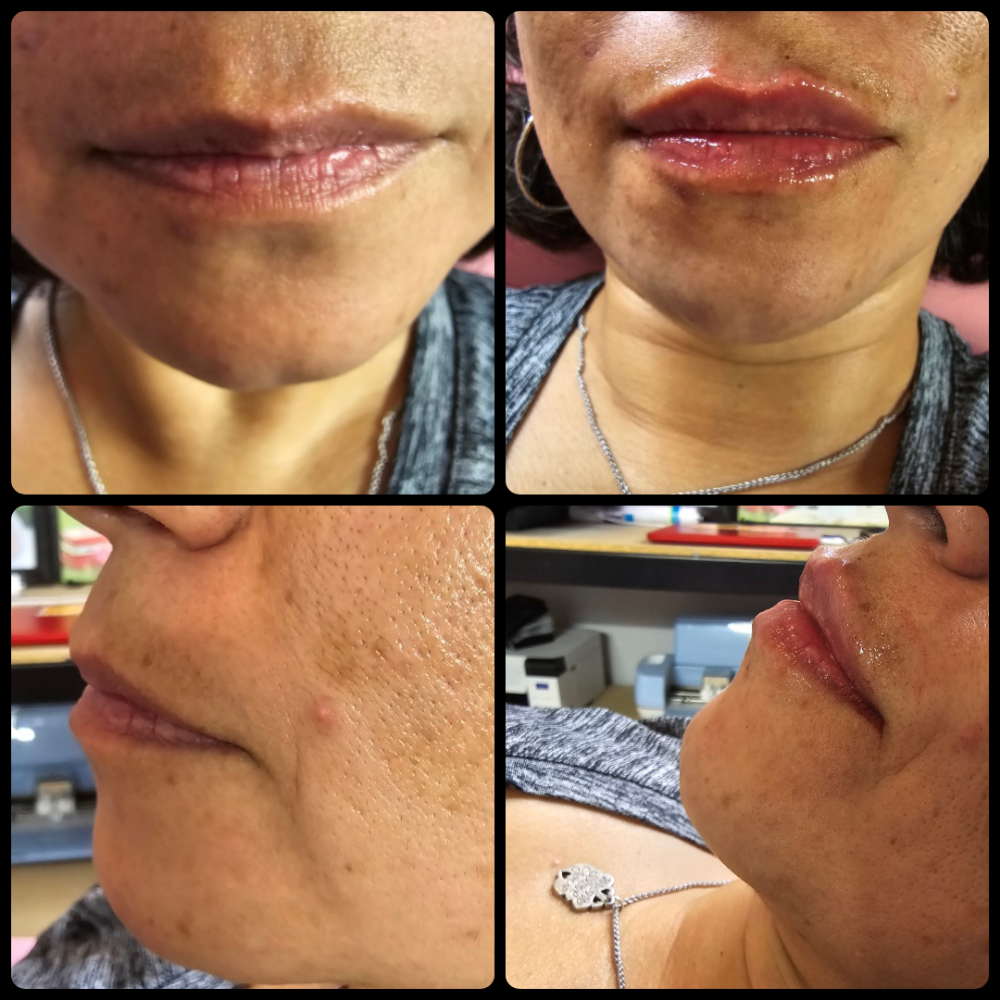 Lip Filler 1/2 Syringe