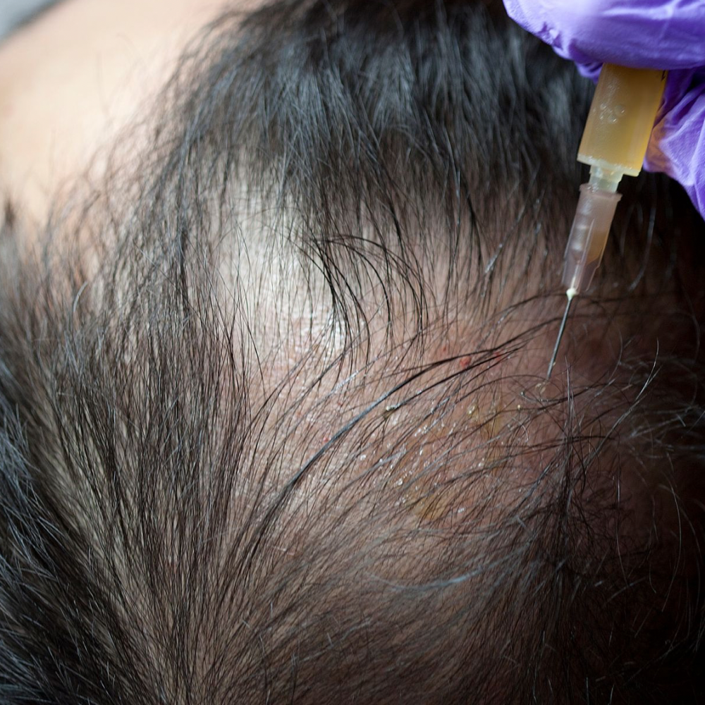 PRP Hair Restoration