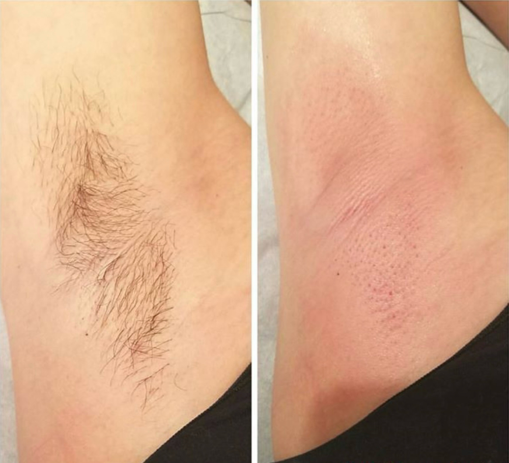 Under Arms Wax