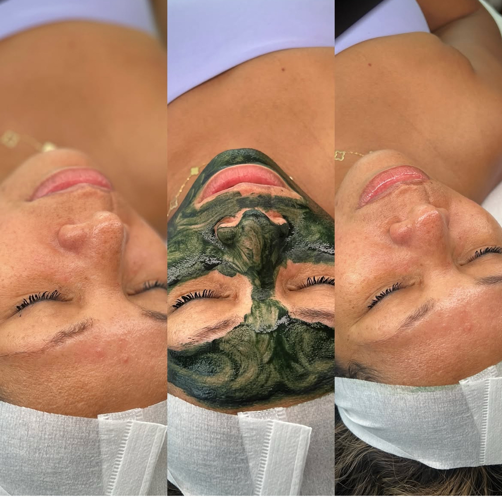 Tier 4 Facial - Microneedling