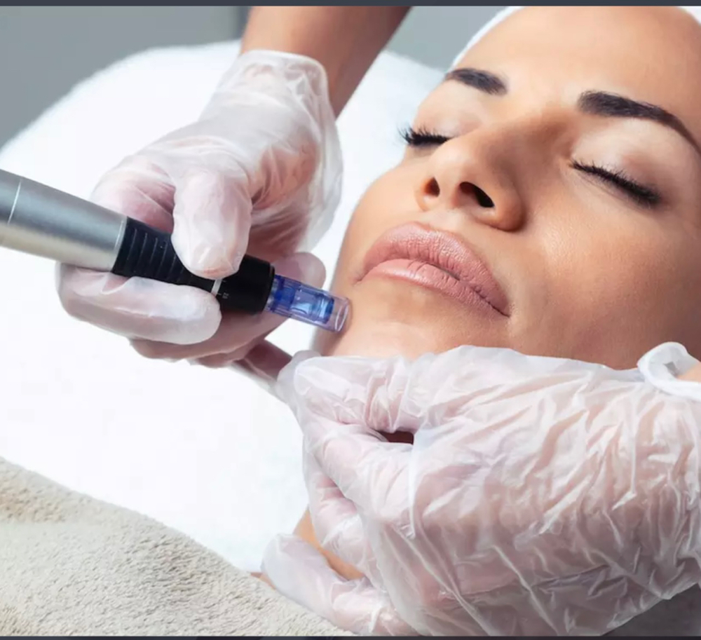 Microneedling Full Face