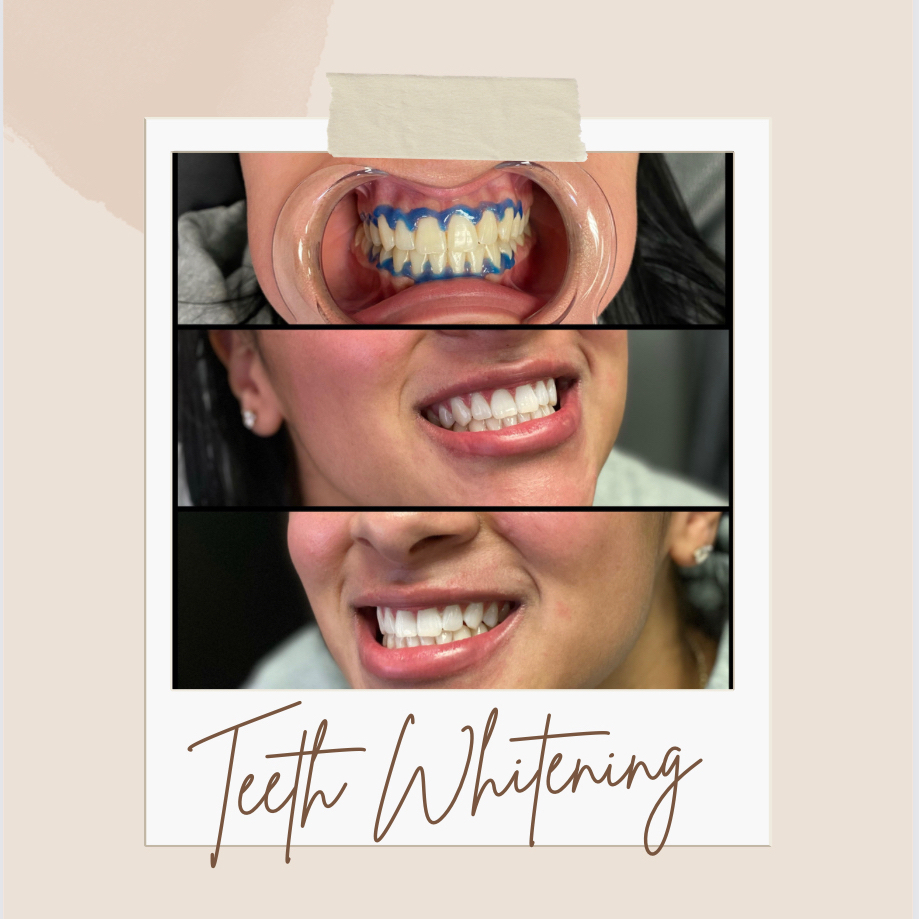 Teeth Whitening 30 Min