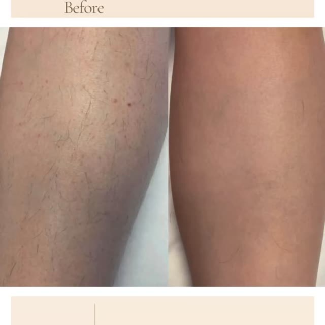 Full Legs Laser Hair Removal at The Beautee Spot in Phoenix, AZ