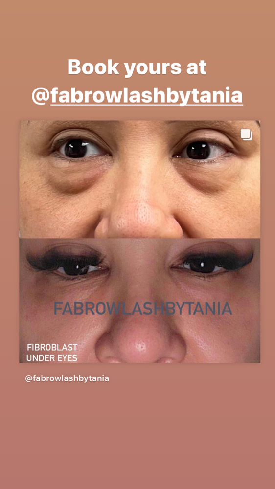 Under Eyes Lift