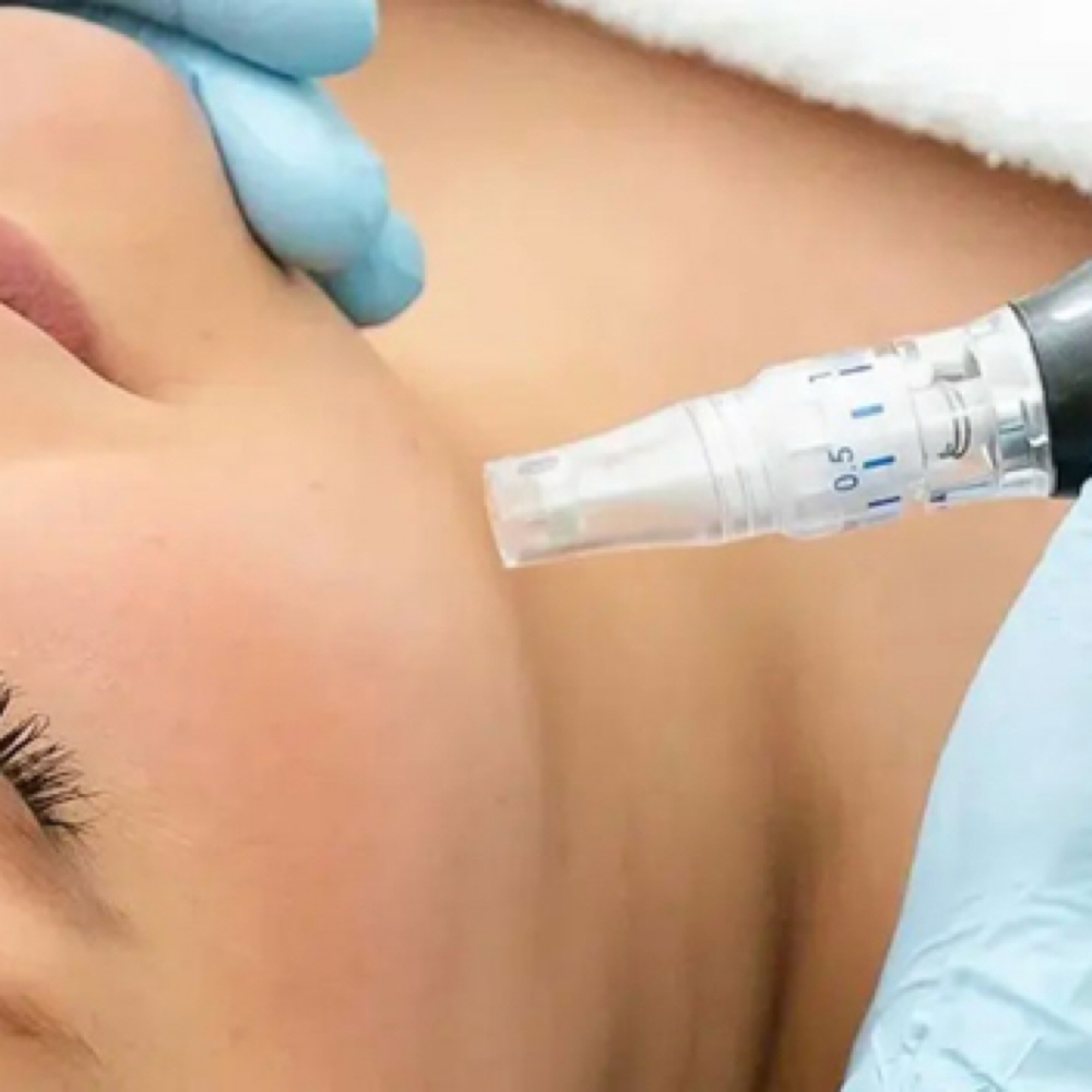 Microneedling Neck Add On at Esthetic By Val in Clinton Township, MI