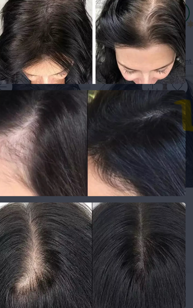 Partial Scalp Pigmentation