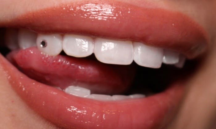 Tooth Gems added during Appointment
