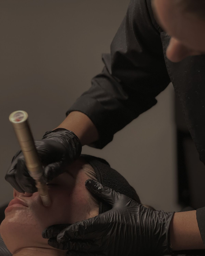 Nanostamp/Microneedling