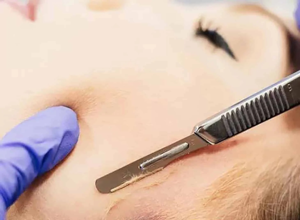 Dermaplane Add On