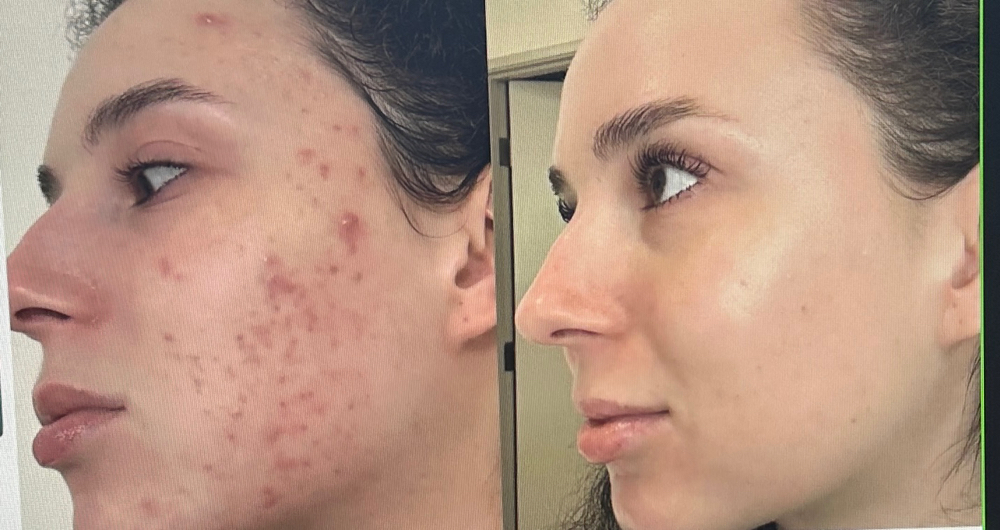Restructa Bio-Booster Peeling