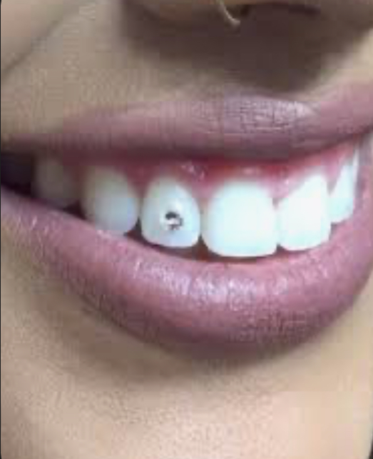 Toothgems