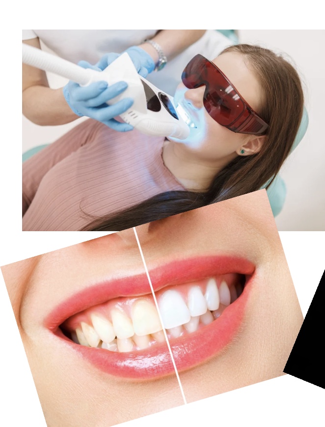 Teeth Whitening