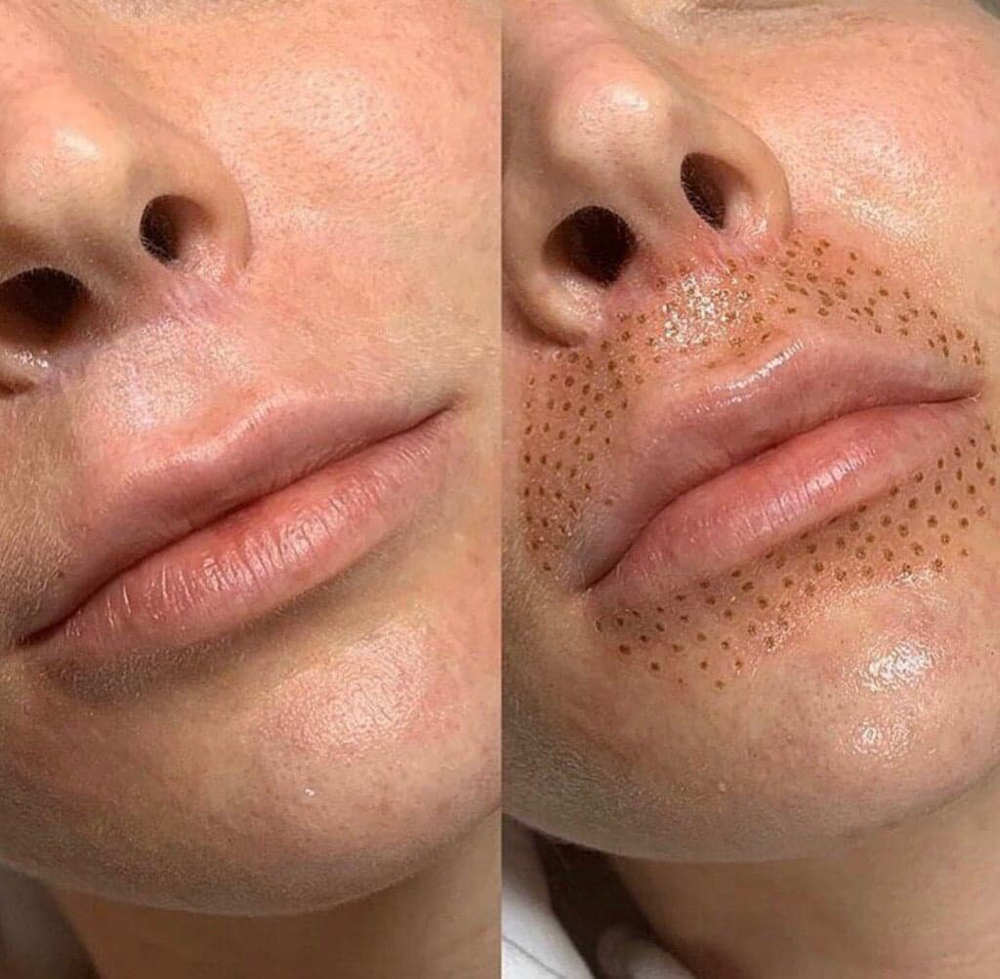 Upper / Lower Lip