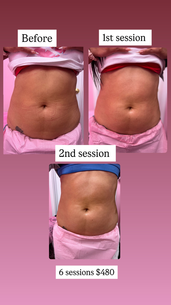 6  Body Sculpting Sessions