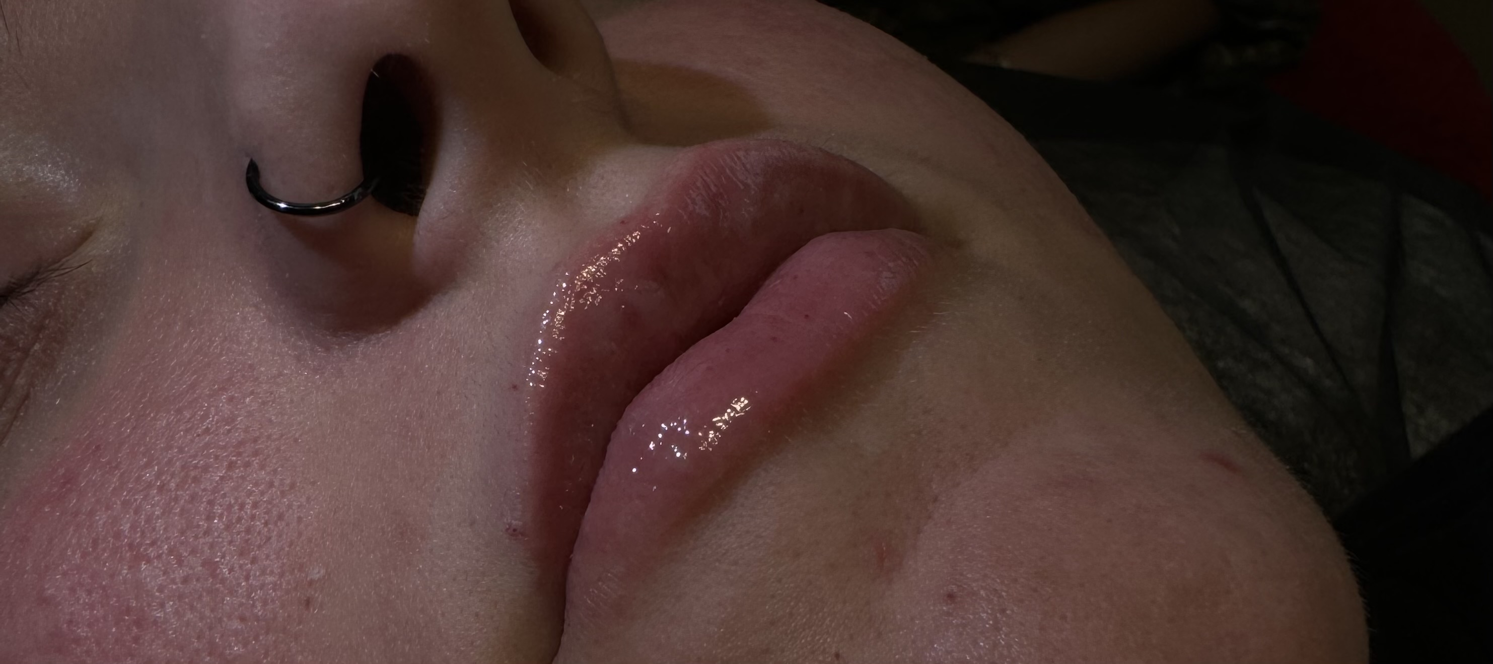 Needle Free Lip Fillers
