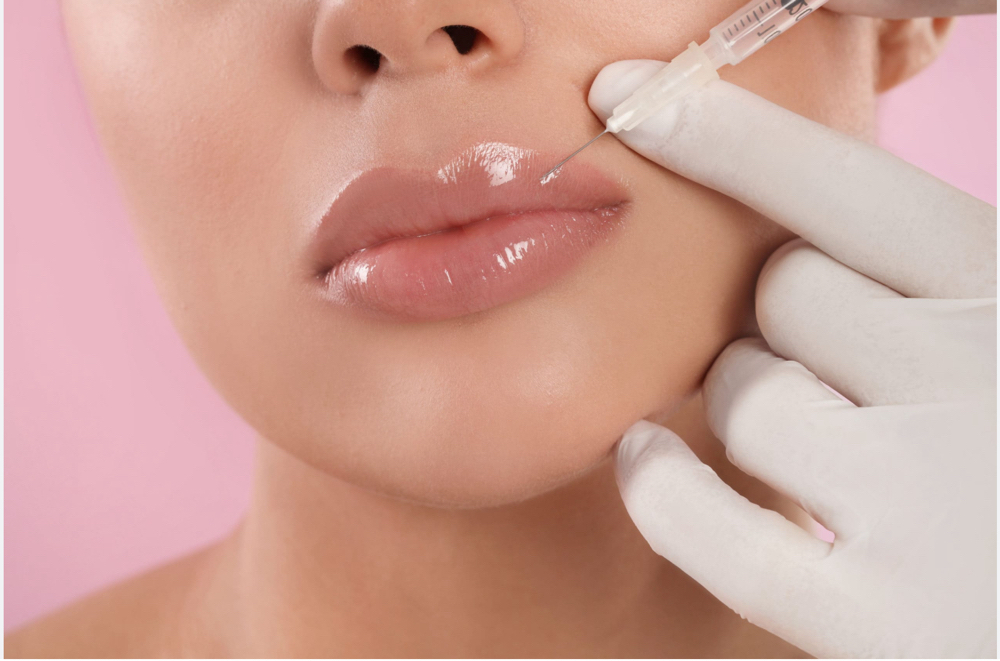 Versa 1ml Lip Filler