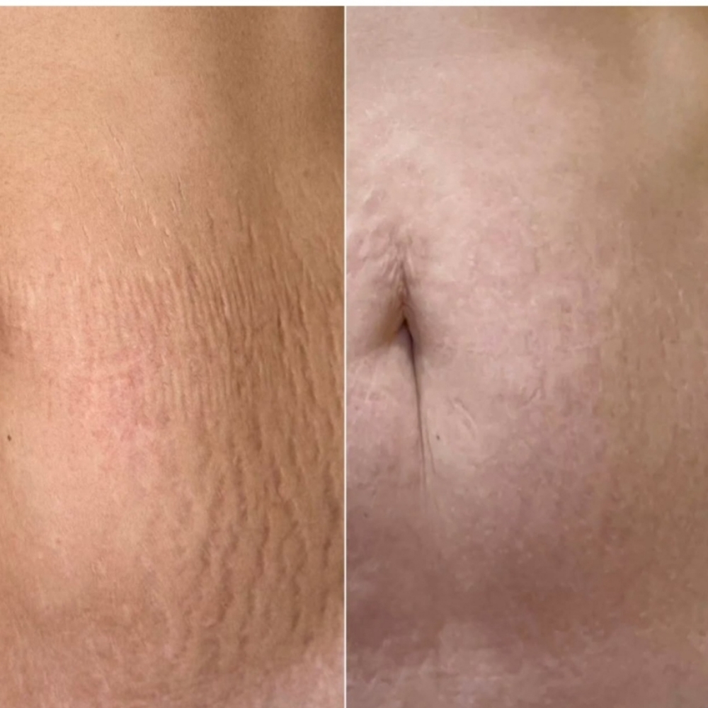 Cold plasma removing stretch marks at Beauty Line in Vancouver, WA