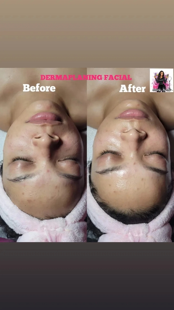 DERMAPLANING FACIAL