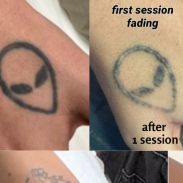 Tattoo Removal XS at Sarasota Laser Lab in Sarasota, FL
