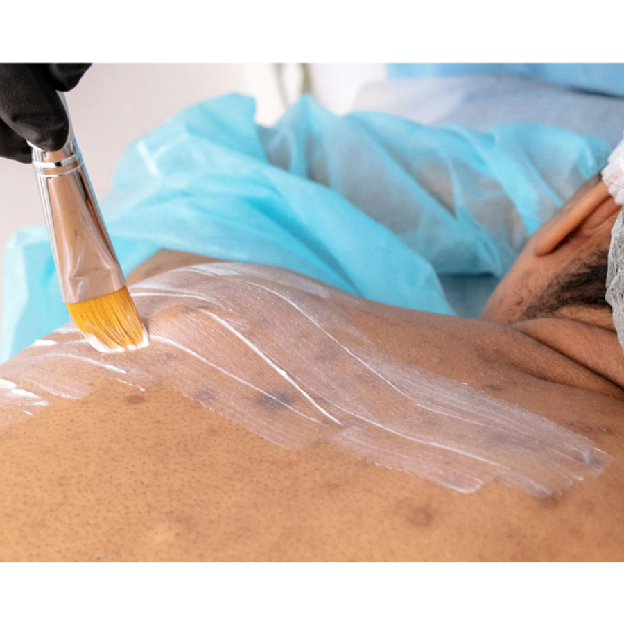 Bacne treatments at Body Essentials HSV, Wellness and Beauty LLP in Huntsville, AL