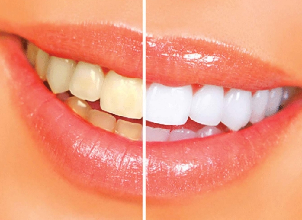 Teeth Whitening
