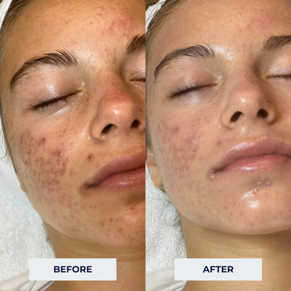 Anti-Acne Facial