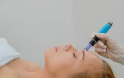 Microneedling