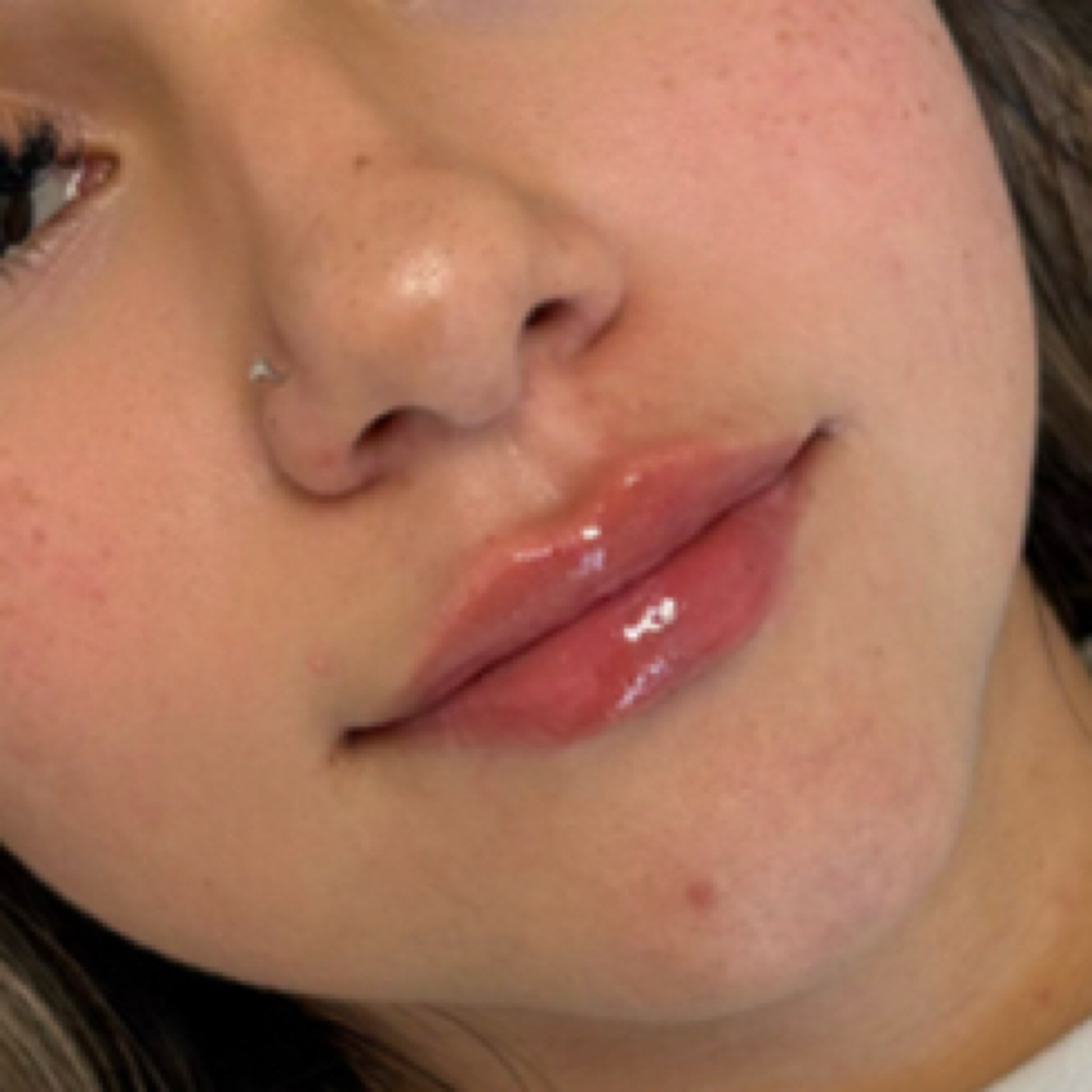 Full Syringe Lip Filler at Omni Beauty Bar in Houston, TX