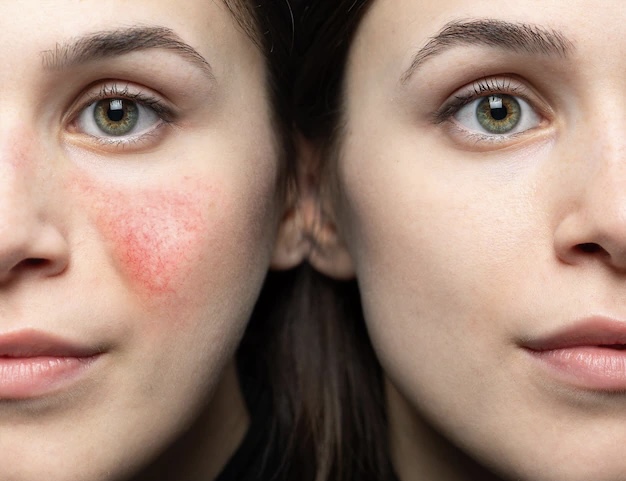 Rosacea Relief Facial