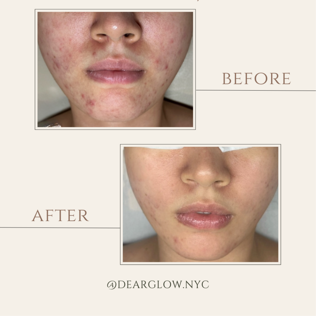 Acne Bootcamp: Returning Clients at Dearglow Skin Studio in New York, NY