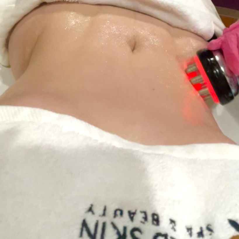 CAVITATION + RF 1 Area at GOLD SKIN SPA AND BEAUTY in MCALLENT, TX