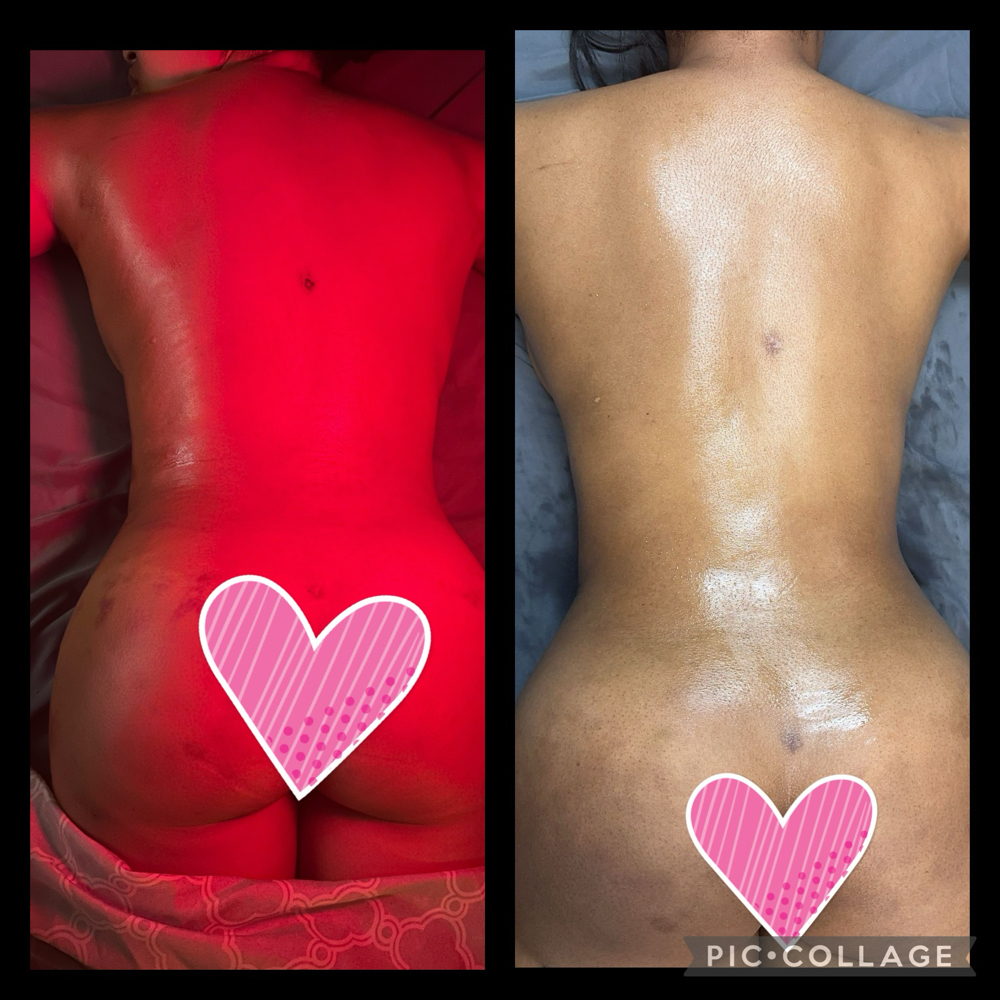 Post-Op Lymphatic Massage (Travel) at N'Vestd Aesthetics in Fairfeild, OH